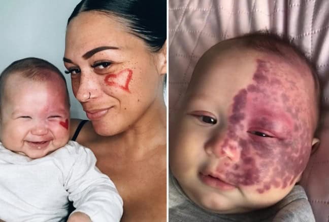 Would You Laser Your Baby’s Face? This Mum Did
