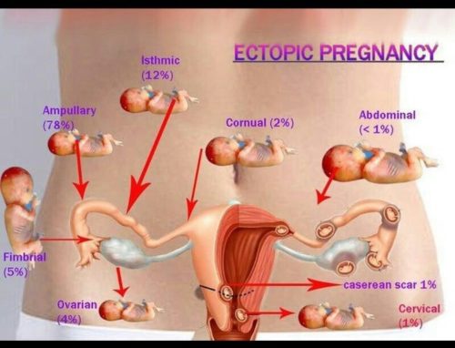 The Early Symptoms Of An Ectopic Pregnancy