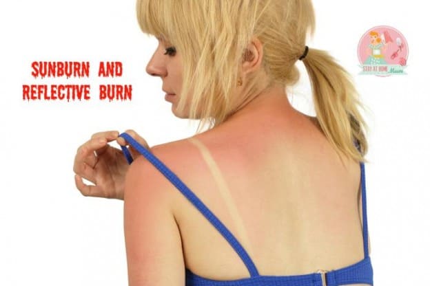 Sunburn and reflective burn on woman's shoulder from sun exposure.