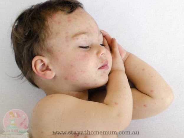 Young child with chicken pox rash on face and arm, showing classic symptoms of chicken pox.
