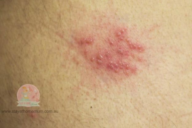 Shingles