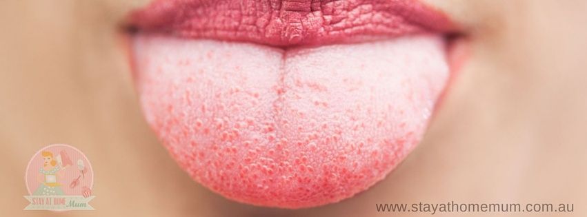 Close-up of a tongue showing bumps and coating, indicating possible oral health issues.