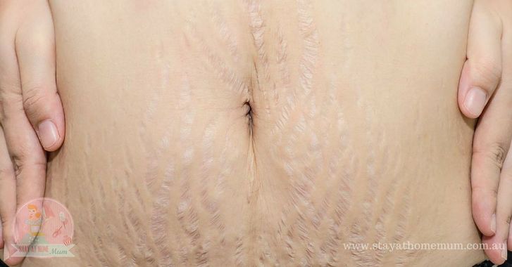 Stretchmarks on the abdomen showing skin lines and texture.