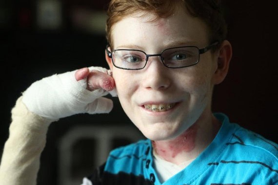 The Life of ‘Butterfly Boy’