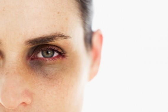 Dark circles under the eye area caused by fatigue or genetics. Learn how to reduce their appearance.