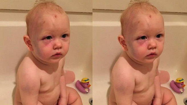 Couple Furious After No Charges Were Filed Vs Babysitter of Son Who They Found “Black and Blue”