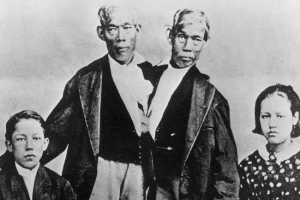 4 Stories of Famous Conjoined Twins