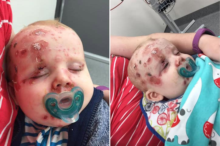 Mum Of Son With Chickenpox Urging People to Vaccinate