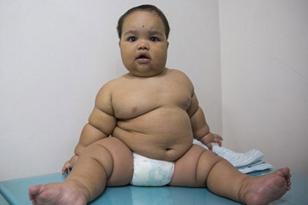 Overweight Toddler in India For Hormone Treatment After Doctors Say His Obesity Was Genetic