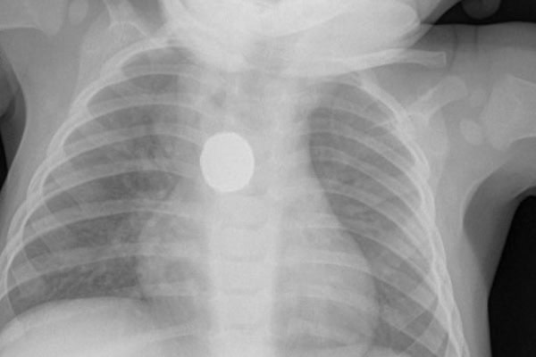 Retailers Adopt New Industry Code For Button Batteries to Prevent Child Deaths and Injuries