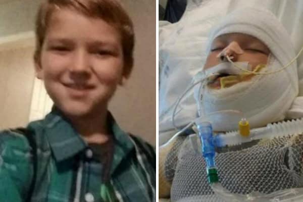 10-Year-Old Boy on Life Support After a Bully Set Him Alight