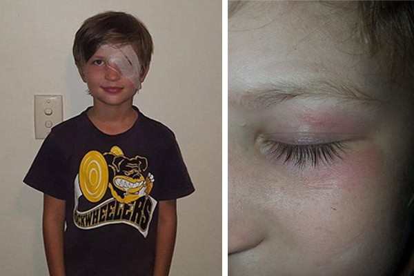 Child with eye injury after magpie attack, needing surgery to save eyesight.