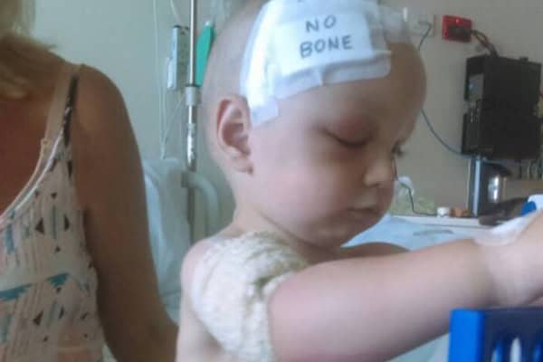 Toddler with bandaged head after skull removal surgery.