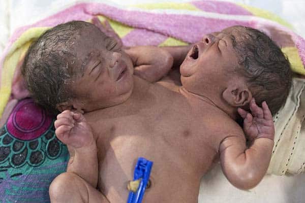 Parents Dump Their Conjoined Twins At a Hospital in Bangladesh