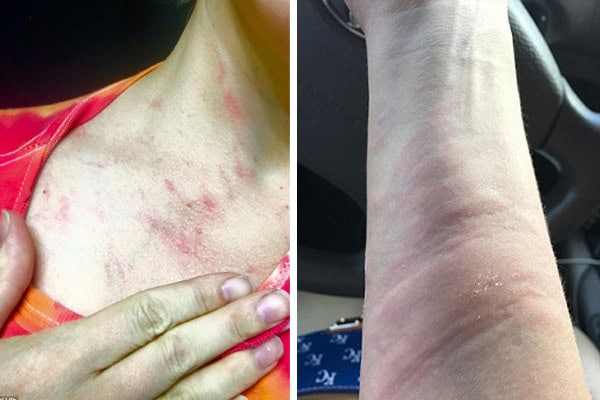 Mum Who is Allergic to Water Battles with Hives Every Time She Sweats or Cries