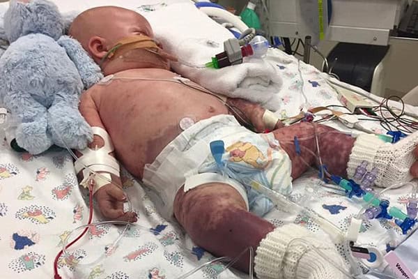 Five-Month-Old Boy Fights For Life After Contracting Meningococcal Disease