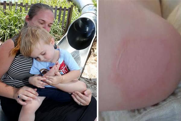 Mum Wants Metal Slides in Playgrounds Removed After Her Son Burns His Foot