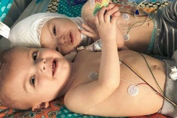 Adorable Video Shows Separated Conjoined Twins Cuddling Each Other Weeks After Surgery | Stay at Home Mum