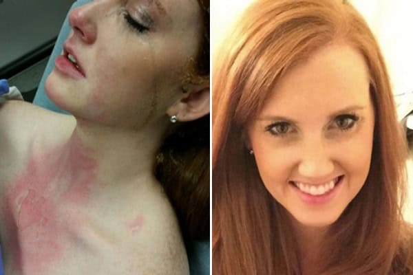 Burned woman before and after treatment for kitchen burn injuries.