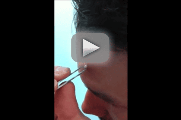 Throw Up Thursday: Massive Blackhead Popped on Forehead