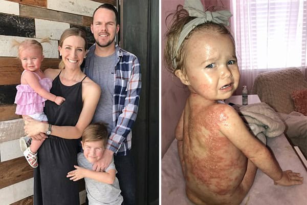 Child with psoriasis showing skin condition, not contagious.