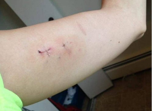 Mum Traumatised After Her Birth Control Implant Goes Missing Inside Her Arm