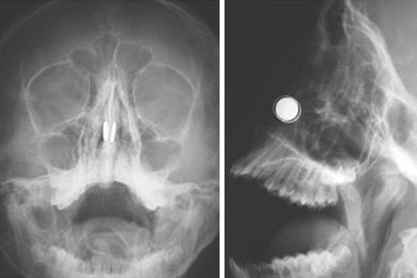 X-ray of a child with two magnets inside the nose.