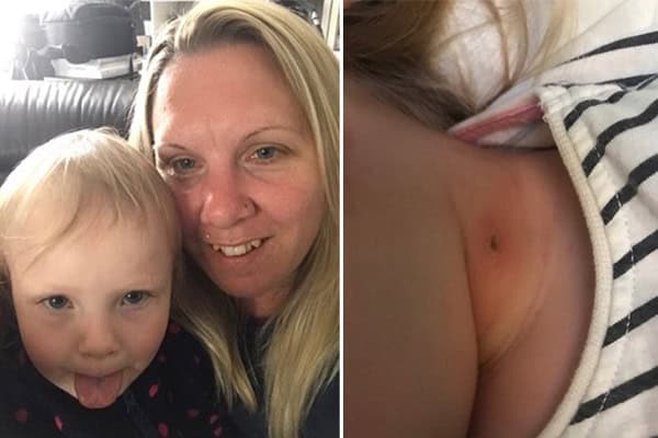 Three-Year-Old Girl Almost Died From Toxic Shock Syndrome After A Cat Scratch