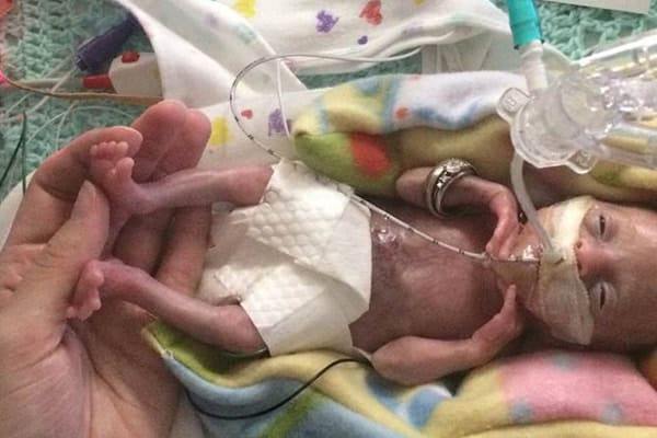 Miracle Baby Born At 21 Weeks Becomes Most Premature Surviving Baby Ever Reported