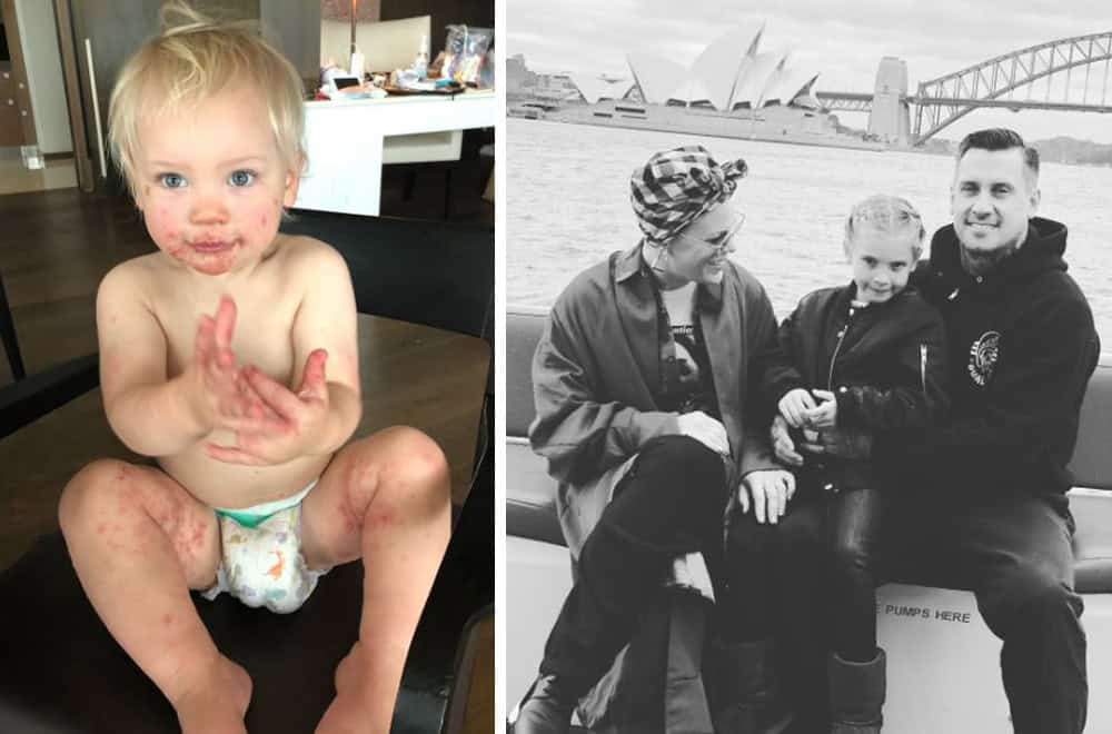 Child with hand-foot-and-mouth disease, showing rash on face and body.