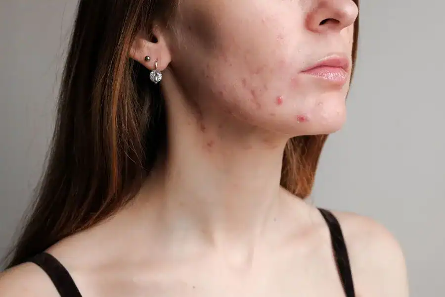How To Deal With Adult Acne